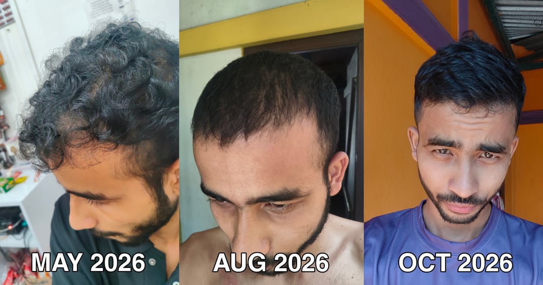 My Hair Regrowth journey (In English), image 2